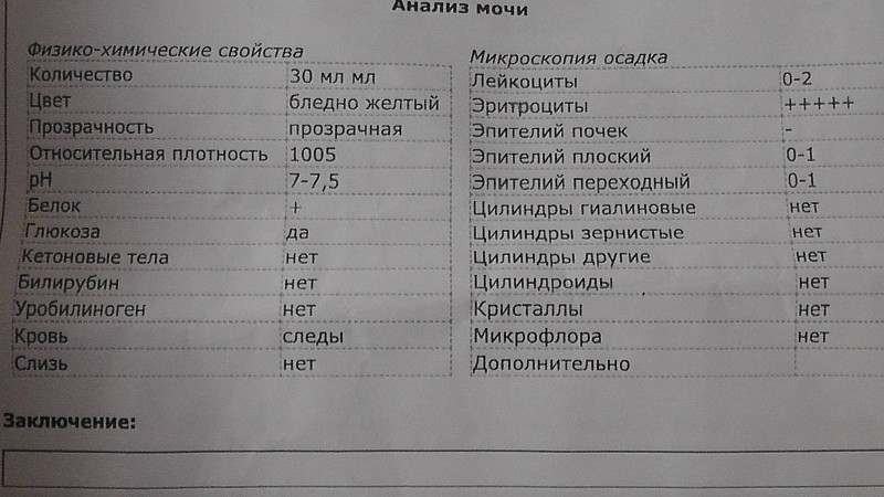 Высокая плотность мочи при сахарном диабете